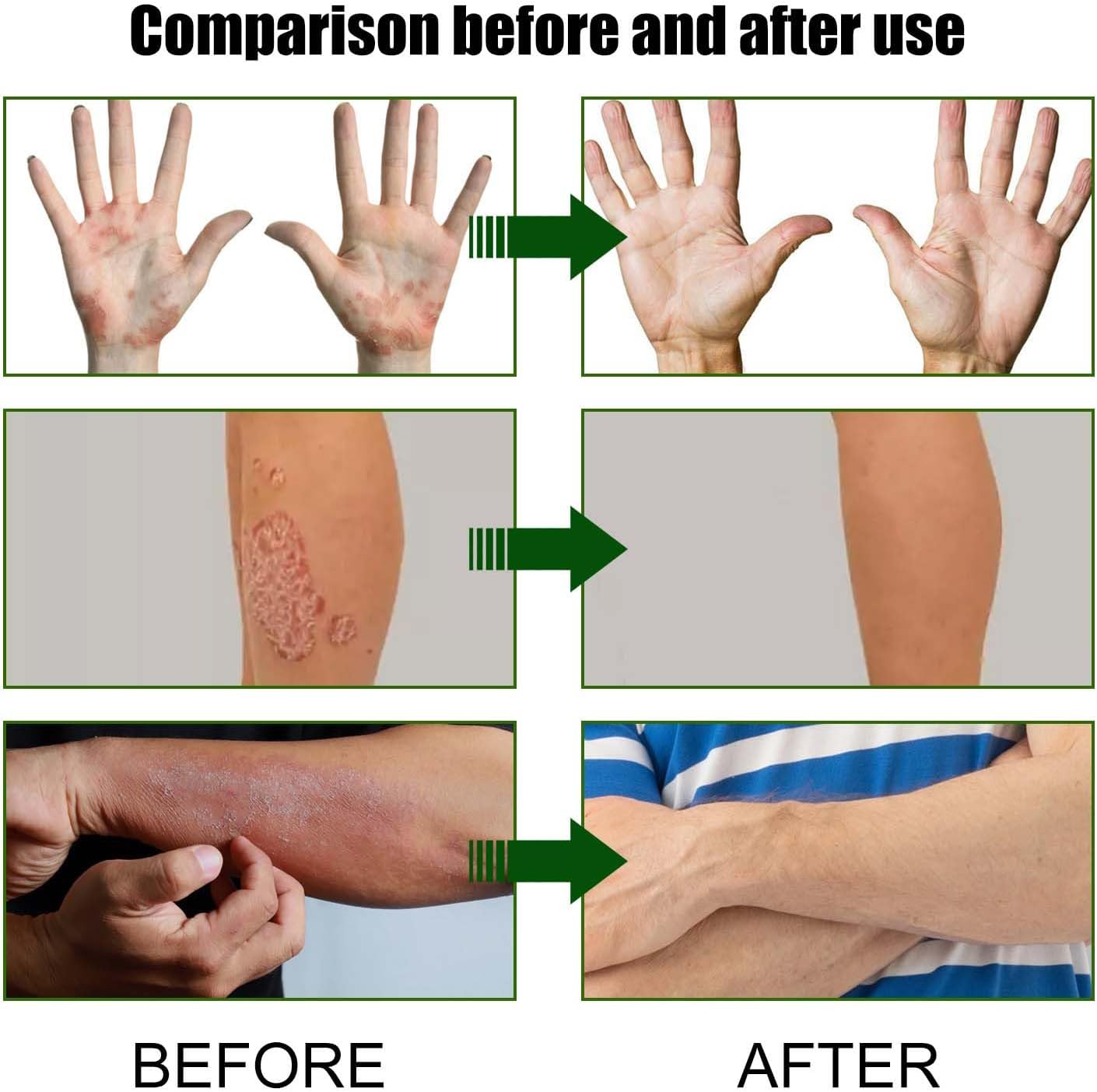 Todahof Bienengift-Psoriasis-Behandlungscreme, Todahof Bienengift-Psoriasis-Behandlungscreme, Todahof Bienengift-Creme, Psoriasis-Creme, Bienengift-Psoriasis-Behandlungscreme (3 Stück)