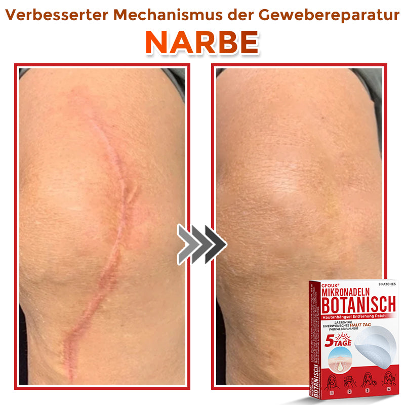GFOUK® Mikronadeln Botanisch Hautanhängsel Entfernung Patch 🇩🇪 Hergestellt in Deutschland