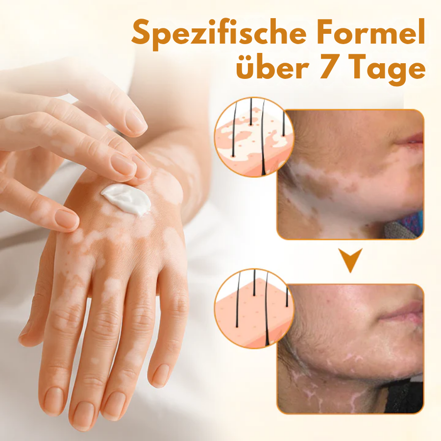 Oveallgo® VitiClear Pro Hautpflegecreme – 90% effektive Linderung bei Vitiligo
