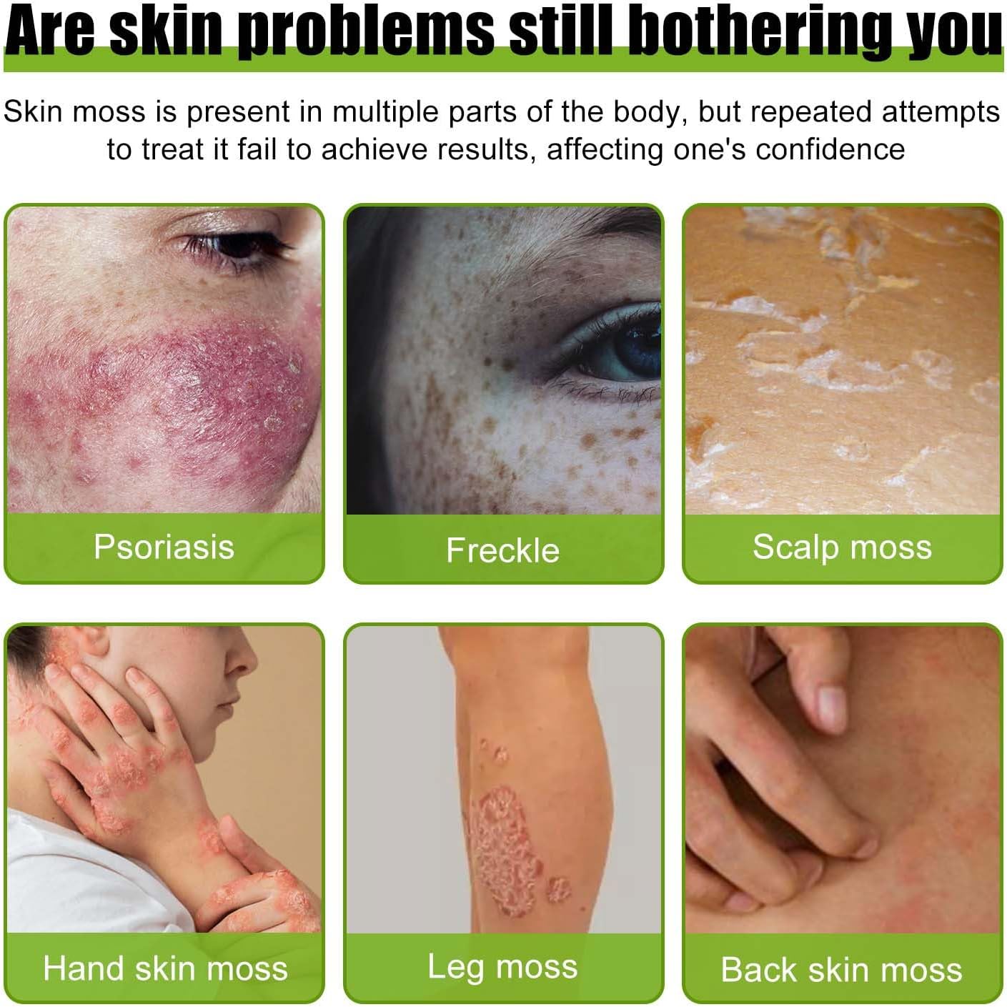 Todahof Bienengift-Psoriasis-Behandlungscreme, Todahof Bienengift-Psoriasis-Behandlungscreme, Todahof Bienengift-Creme, Psoriasis-Creme, Bienengift-Psoriasis-Behandlungscreme (3 Stück)