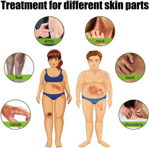 Todahof Bienengift Psoriasis Behandlungscreme, Todahof Bienengift Psoriasis Behandlungscreme, Todahof Bienengift Creme, Psoriasis Creme, Bienengift Psoriasis Behandlungscreme (3 Stück)