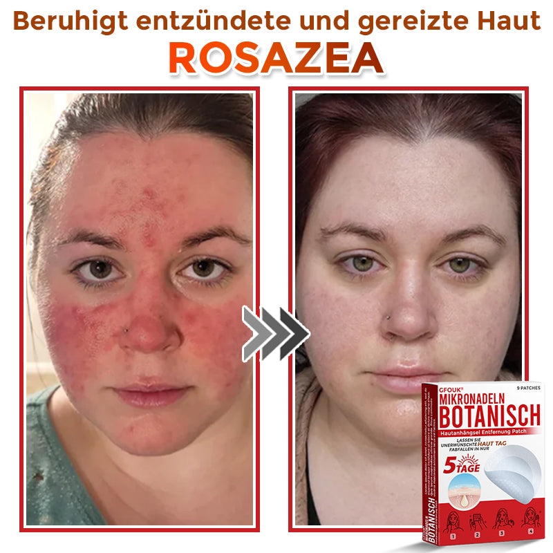 GFOUK® Mikronadeln Botanisch Hautanhängsel Entfernung Patch 🇩🇪 Hergestellt in Deutschland