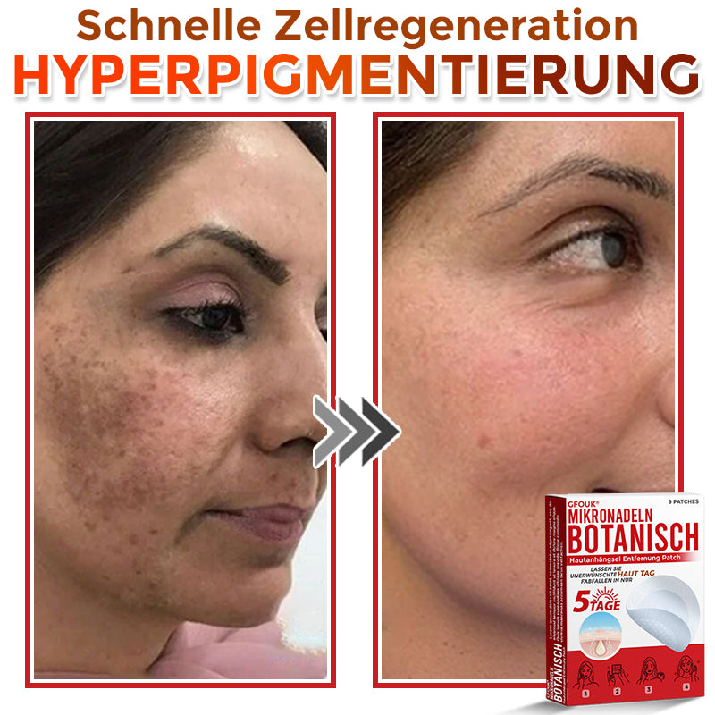 GFOUK® Mikronadeln Botanisch Hautanhängsel Entfernung Patch 🇩🇪 Hergestellt in Deutschland
