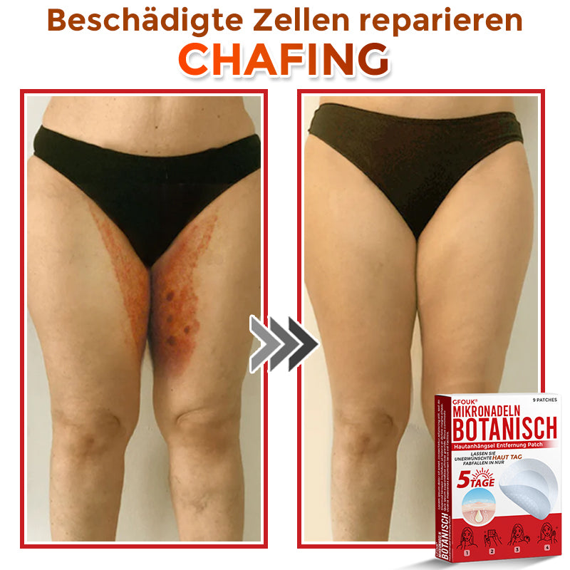GFOUK® Mikronadeln Botanisch Hautanhängsel Entfernung Patch 🇩🇪 Hergestellt in Deutschland