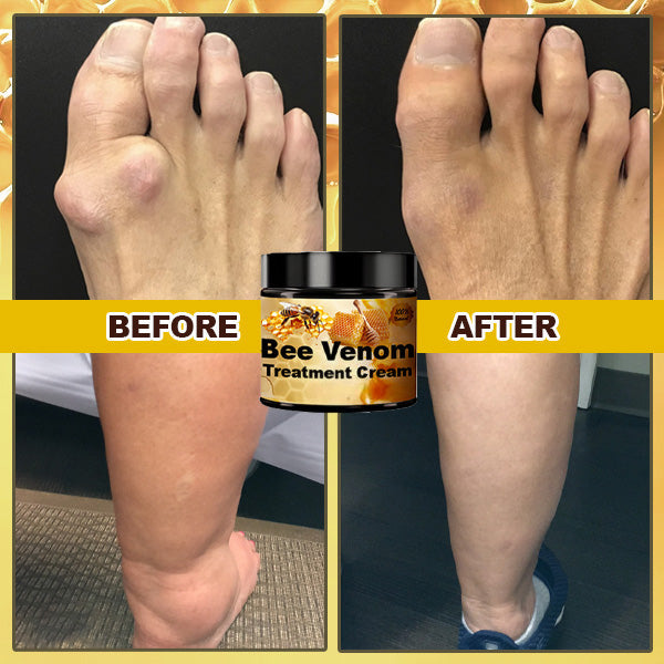 Bienengift-Creme zur Behandlung von Arthritis